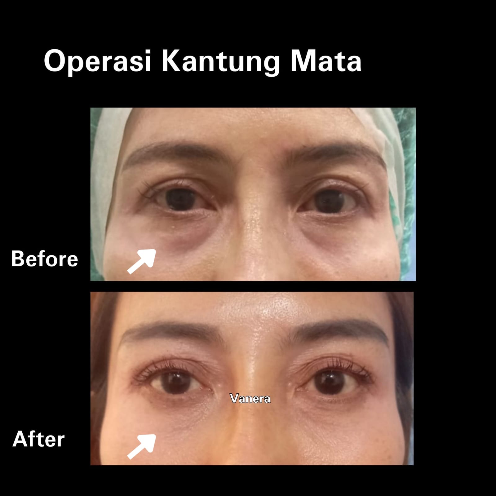 Before after operasi kelopak mata