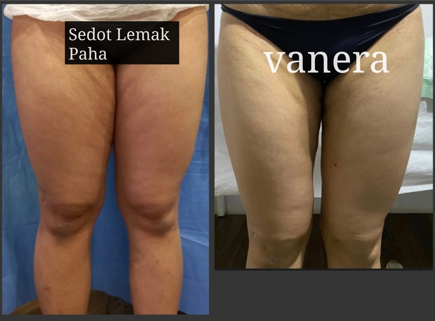 Before after liposuction paha