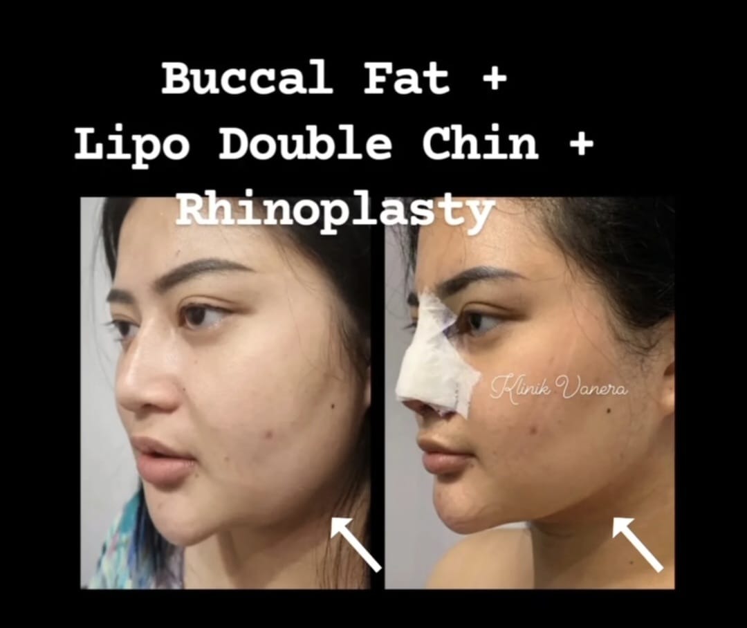 Before after operasi hidung